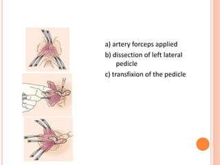 a) artery forceps applied
b) dissection of left lateral
pedicle
c) transfixion of the pedicle
 