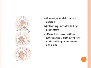 (a) Haemorrhoidal tissue is
excised
(b) Bleeding is controlled by
diathermy
(c) Defect is closed with a
continuous suture after first
undermining anoderm on
each side
 