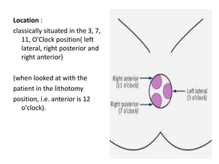 Location :
classically situated in the 3, 7,
11, O’Clock position( left
lateral, right posterior and
right anterior)
(when looked at with the
patient in the lithotomy
position, i.e. anterior is 12
o'clock).
 