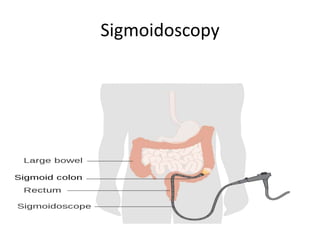 Sigmoidoscopy
 