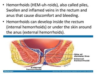 • Hemorrhoids (HEM-uh-roids), also called piles,
Swollen and inflamed veins in the rectum and
anus that cause discomfort and bleeding.
• Hemorrhoids can develop inside the rectum
(internal hemorrhoids) or under the skin around
the anus (external hemorrhoids).
 