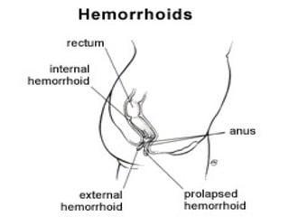 Management of Haemorrhoids by Prof Ganiyu Rahman | PPT