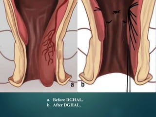 a. Before DGHAL.
b. After DGHAL.
 
