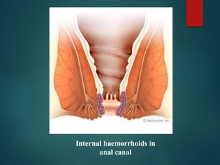 Internal haemorrhoids in
anal canal
 