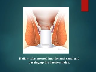 Hollow tube inserted into the anal canal and
pushing up the haemorrhoids.
 