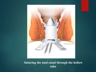 Suturing the anal canal through the hollow
tube
 