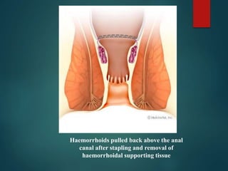 Haemorrhoids pulled back above the anal
canal after stapling and removal of
haemorrhoidal supporting tissue
 