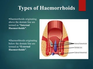 Types of Haemorrhoids
Haemorrhoids originating
above the dentate line are
termed as “Internal
Haemorrhoids”.
Haemorhhoids originating
below the dentate line are
termed as “External
Haemorrhoids”.
 