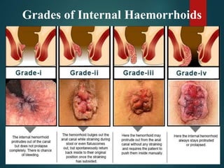 Grades of Internal Haemorrhoids
 