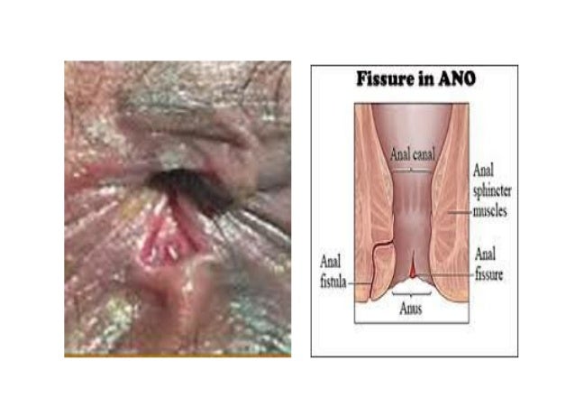 Haemorroids Fissure Fistula In Ano