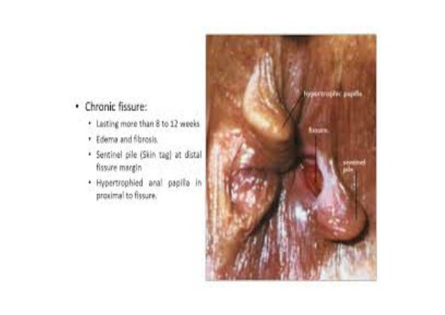 Haemorroids Fissure Fistula In Ano