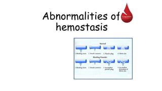Abnormalities of
hemostasis
 
