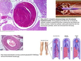 Haemostasis, Thrombosis, Embolism, infarction....pdf
