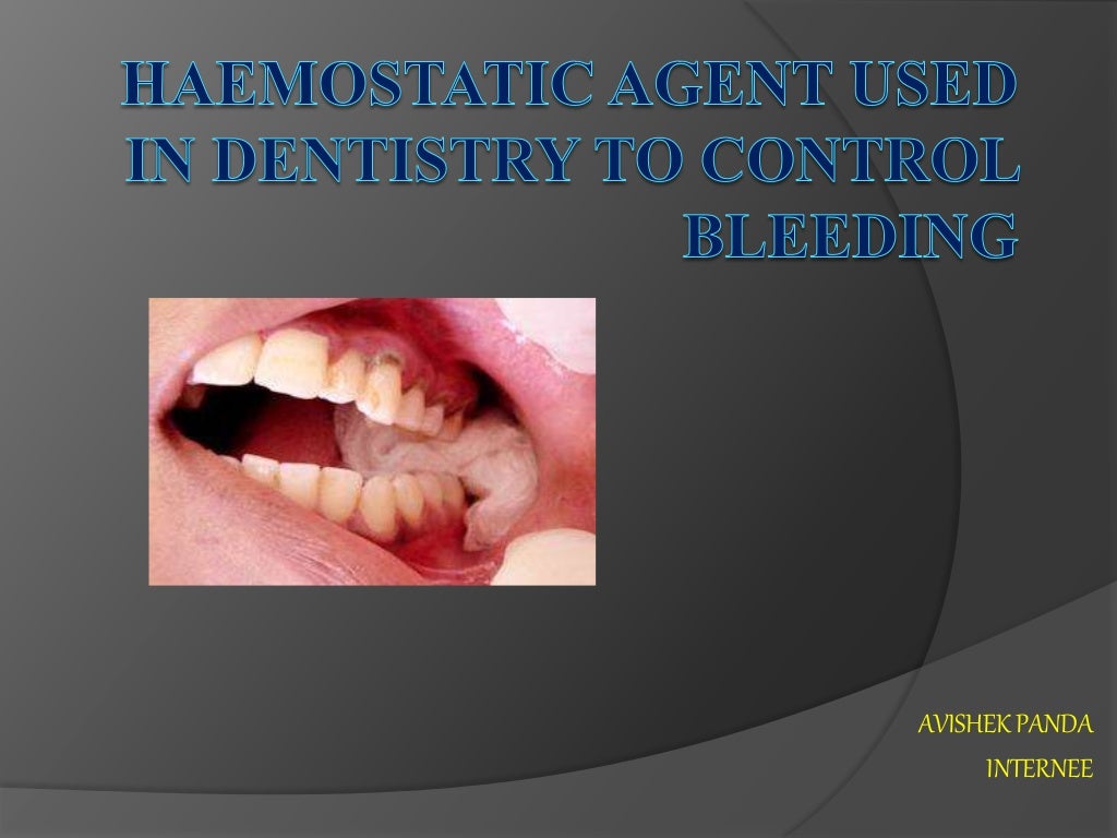 Haemostatic agent used in dentistry to control bleeding