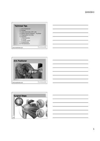 23/03/2013!




   Technical Tips
             1.  Arm Positioner
             2.  Portals
             3.  Long Cannulae with Lids
             4.  Sharp Suture Passers - AcuPass
             5.  Disposable Drill Bits
             6.  Anchors
                1.  Biocomposites
                2.  Curved
                3.  Double Loaded
             7.  Anaesthesia
             8.  Rehabilitation

                                                  13
www.wrightington.com




  Arm Positioner




                                                  14
www.wrightington.com




  Surgical Steps




                                                  15
www.wrightington.com




                                                                5!
 