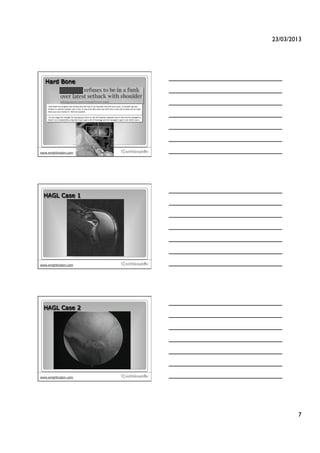 23/03/2013!




   Hard Bone




                       19
www.wrightington.com




  HAGL Case 1




                       20
www.wrightington.com




  HAGL Case 2




                       21
www.wrightington.com




                                     7!
 
