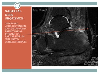 SAGITTAL
STIR
SEQUENCE
THICKENED
ACHILLES TENDON
AND INTERSPREAD
BRIGHT SIGNAL
STREAKS S/O
PARTIAL TEAR IN
THE DISTAL
ACHILLES TENDON.
 