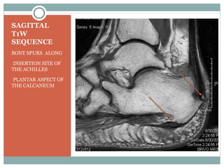 SAGITTAL
T1W
SEQUENCE
BONY SPURS ALONG
•INSERTION SITE OF
THE ACHILLES
•PLANTAR ASPECT OF
THE CALCANEUM
 