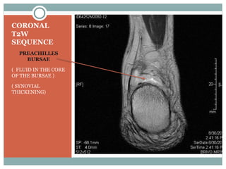 CORONAL
T2W
SEQUENCE
  PREACHILLES
    BURSAE

( FLUID IN THE CORE
OF THE BURSAE )

( SYNOVIAL
THICKENING)
 