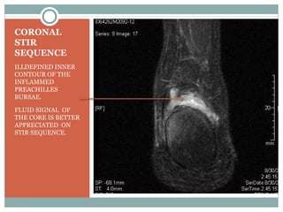 CORONAL
STIR
SEQUENCE
ILLDEFINED INNER
CONTOUR OF THE
INFLAMMED
PREACHILLES
BURSAE.

FLUID SIGNAL OF
THE CORE IS BETTER
APPRECIATED ON
STIR SEQUENCE.
 