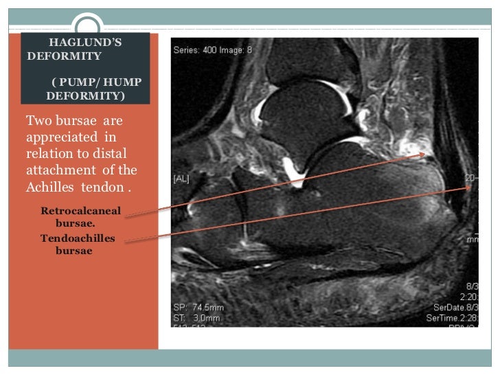 Haglunds deformity