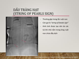 DẤU TRÀNG HẠT
(STRING OF PEARLS SIGN)
From: Case courtesy of Dr Maulik S Patel, Radiopaedia.org, rID: 13853
- Thường gặp t...