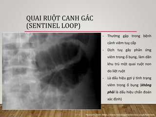 QUAI RUỘT CANH GÁC
(SENTINEL LOOP)
- Thường gặp trong bệnh
cảnh viêm tuỵ cấp
- Dịch tuỵ gây phản ứng
viêm trong ổ bụng, là...