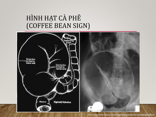 HÌNH HẠT CÀ PHÊ
(COFFEE BEAN SIGN)
Picstures from: https://nomsgalore.wordpress.com/tag/coffee/
 