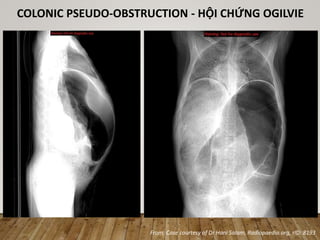 From: Case courtesy of Dr Hani Salam, Radiopaedia.org, rID: 8193
COLONIC PSEUDO-OBSTRUCTION - HỘI CHỨNG OGILVIE
 