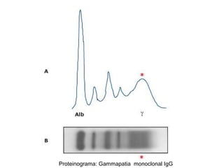 Proteinograma: Gammapatia  monoclonal IgG 