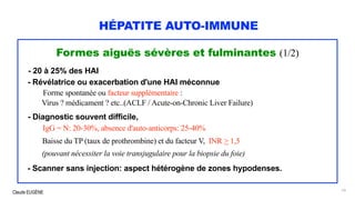 Claude EUGÈNE
HÉPATITE AUTO-IMMUNE
Formes aiguës sévères et fulminantes (1/2)
- 20 à 25% des HAI
- Révélatrice ou exacerbation d'une HAI méconnue
Forme spontanée ou facteur supplémentaire :
Virus ? médicament ? etc..(ACLF / Acute-on-Chronic Liver Failure)
- Diagnostic souvent difficile,
IgG = N: 20-30%, absence d'auto-anticorps: 25-40%
Baisse du TP (taux de prothrombine) et du facteur V, INR > 1,5
(pouvant nécessiter la voie transjugulaire pour la biopsie du foie)
- Scanner sans injection: aspect hétérogène de zones hypodenses.
14
 