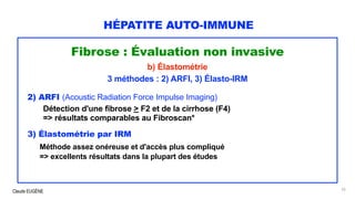 Claude EUGÈNE
HÉPATITE AUTO-IMMUNE
Fibrose : Évaluation non invasive
b) Élastométrie
3 méthodes : 2) ARFI, 3) Élasto-IRM
2) ARFI (Acoustic Radiation Force Impulse Imaging)
Détection d'une fibrose > F2 et de la cirrhose (F4)
=> résultats comparables au Fibroscan*
3) Élastométrie par IRM
Méthode assez onéreuse et d'accès plus compliqué
=> excellents résultats dans la plupart des études
52
 