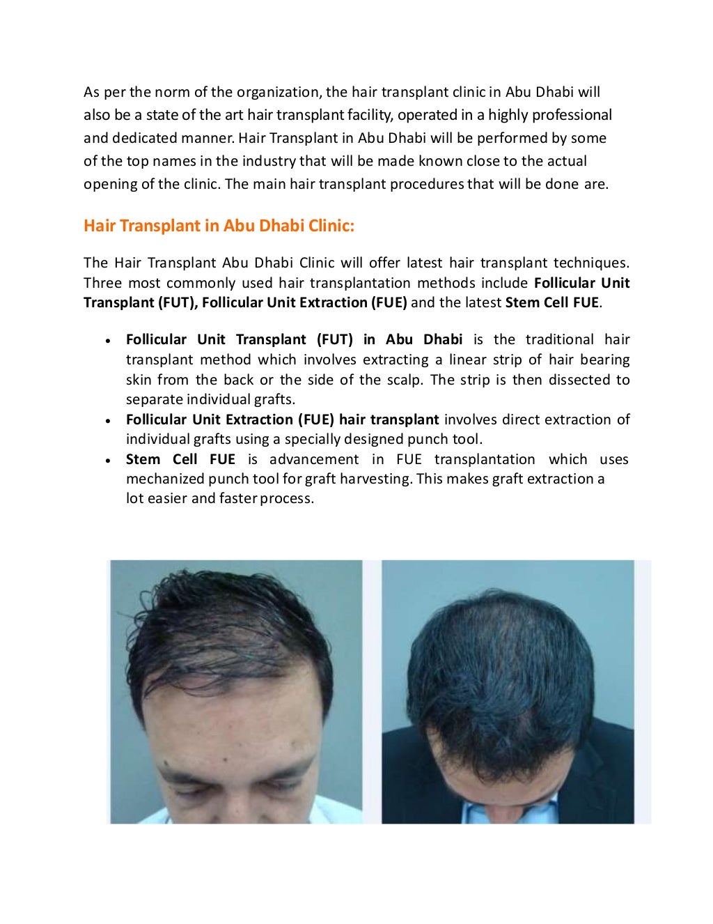 Hair Transplant in Abu Dhabi UAE