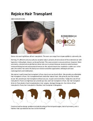 Rejoice Hair Transplant
WIDE DONOR SCARS
Donor-site scarring follows all hair transplants. The scars can range from imperceptible to extremely de-
Forming. If sufficient and unusually lax occipital scalp is present, direct excision of the widened scar with
layered or trichophytic closure can be performed. This case scenario is very uncommon, however. More
commonly, a broad and unsatisfactory donor-site scar is present because excessive scalp has been
removed during harvest and excessive tension on the wound closure has resulted in a wide scar. In the
past, the author has used a W-plasty scar revision and other approaches utilizing local tissue
rearrangement and mobilization.
We rejoice is well known hair transplant in Pune due to our work and effort. We provide you affordable
hair transplant in Pune. Our transplanted hairs looks like natural hairs. We solve all your hair related
issues. We provide you hair transplant without any cut, no pain and no stitches. Today the cost of hair
transplant in Pune is at high bout we provide you low cost hair transplant in Pune. Our hair transplant
clinics in Pune deals in hair transplantation, hair surgery, damage therapy etc. Our clinics of hair
transplant in Pune, hair transplant in Mumbai, hair transplant in Bangalore.
Common hairline design problems include blunting of the temporal angles, lack of symmetry, and a
hairline that is positioned too low on the forehead.
 