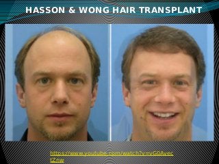 HASSON & WONG HAIR TRANSPLANT
https://www.youtube.com/watch?v=vG0Avec
tZnw
 