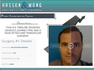 PATIENT TRANSFORMATION TIMELINE
DAVID'S STORY
THIS IS A TIMELINE SHOWING
DAVIDS'S JOURNEY PRE AND A
YEAR AFTER HAIR TRANSPLANT
SURGERY
 