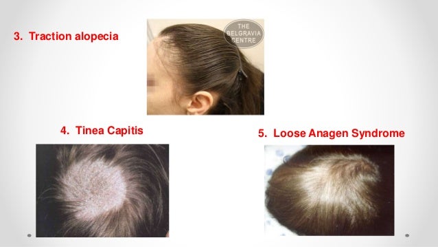 Hair Breakage Disorders