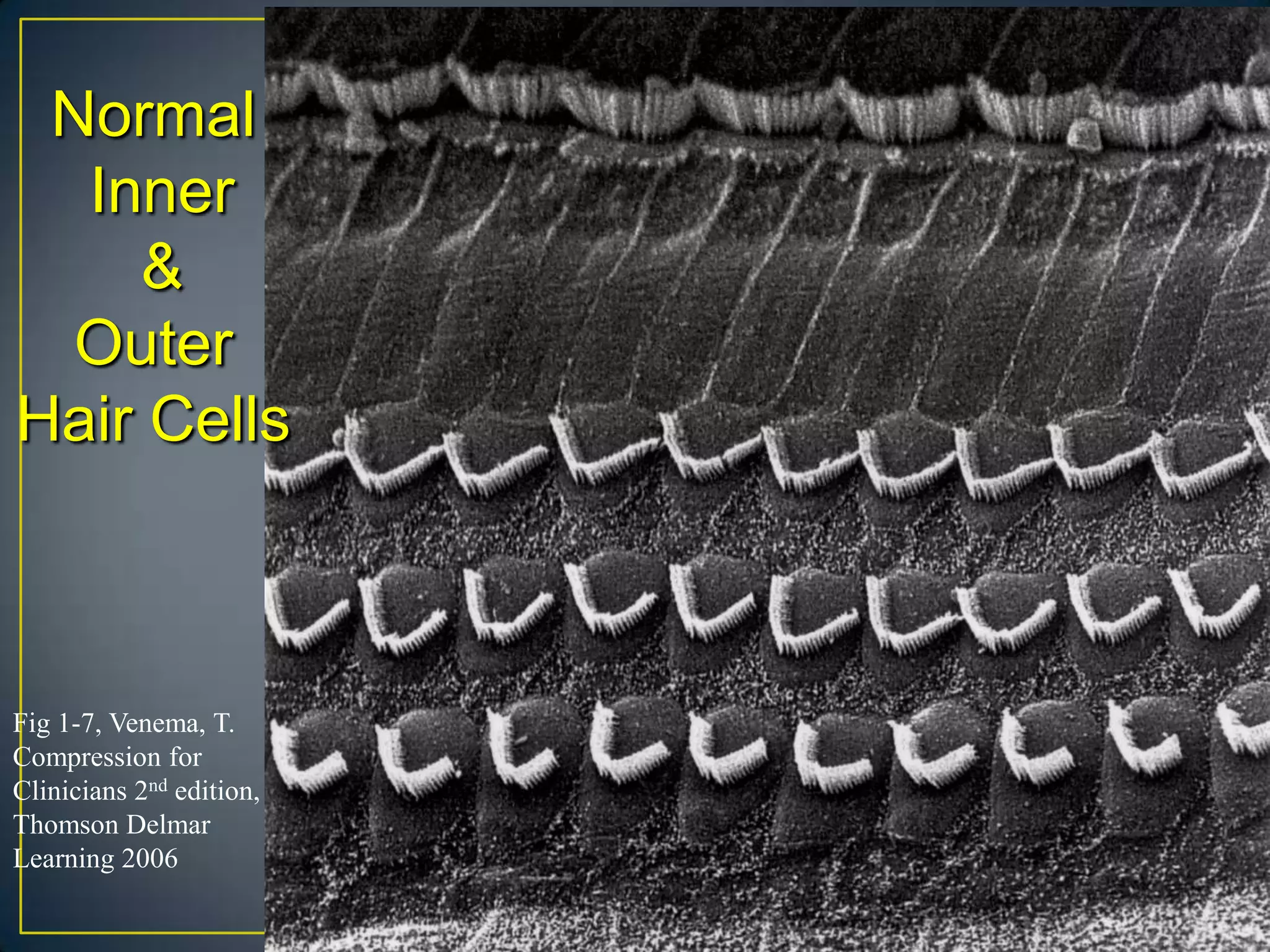 Normal
  Inner
     &
  Outer
Hair Cells



Fig 1-7, Venema, T.
Compression for
Clinicians 2nd edition,
Thomson Delmar
Learning 2006
 