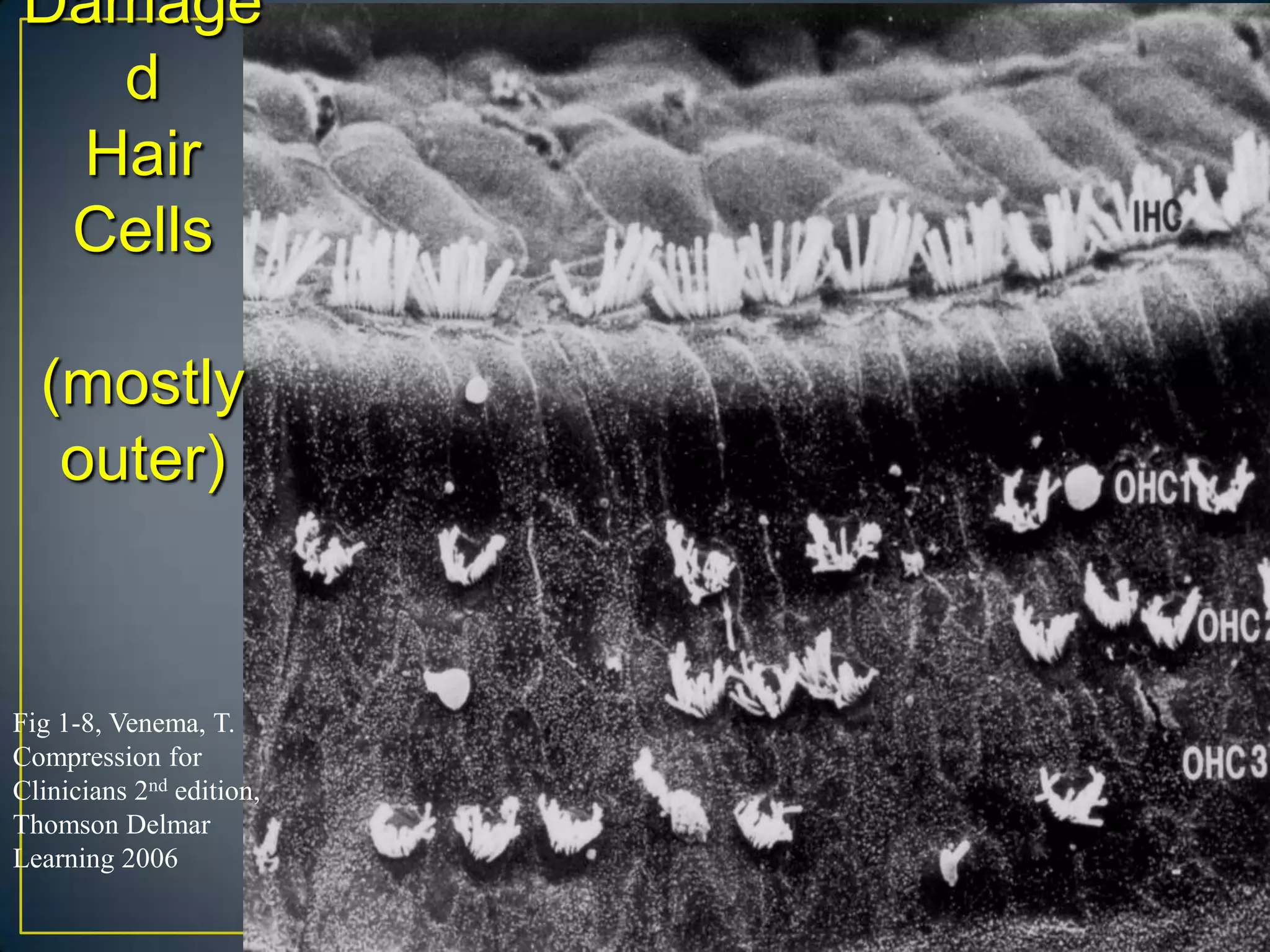 Damage
  d
 Hair
 Cells

  (mostly
   outer)


Fig 1-8, Venema, T.
Compression for
Clinicians 2nd edition,
Thomson Delmar
Learning 2006
 