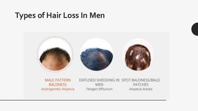 Hair Loss Amp Alopecia Treatment For Men