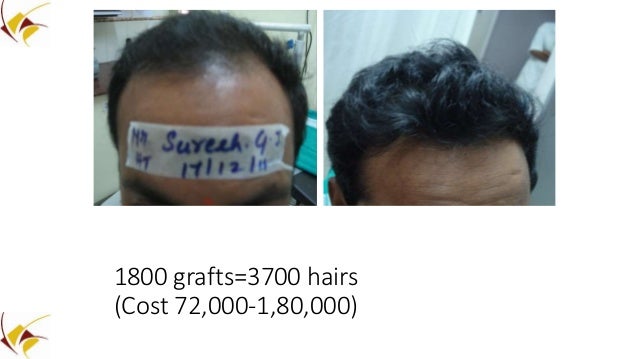 Hair Transplant Presentation By Dr Venkataram Mysore Bangalore