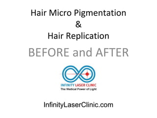 Hair Micro Pigmentation
&
Hair Replication
BEFORE and AFTER
InfinityLaserClinic.com
 