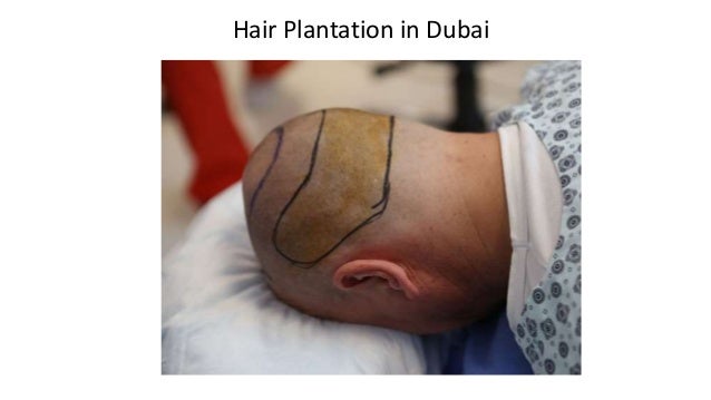 Hair Plantation in Dubai
 