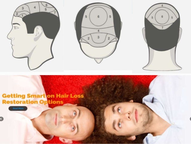 Hair Restoration Hair Transplant Orange County Popular Hairdoctors