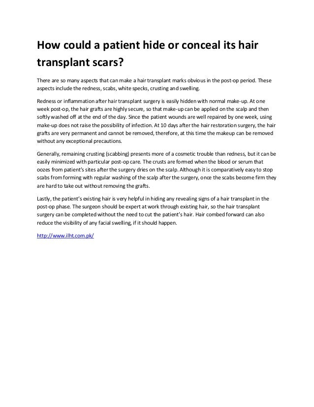 How Could A Patient Hide Or Conceal Its Hair Transplant Scars