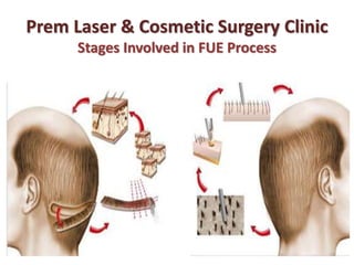 Prem Laser & Cosmetic Surgery Clinic
Stages Involved in FUE Process
 