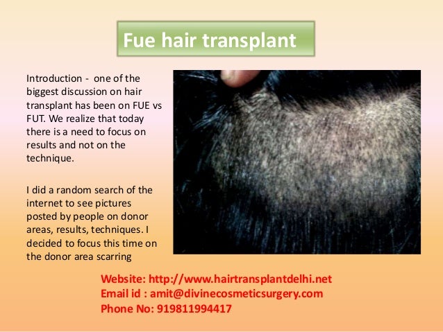 Hair transplant Slide 2