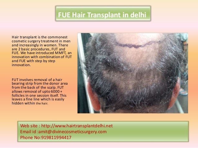 Hair transplant Slide 3