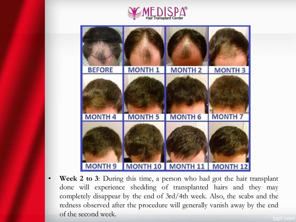 After Hair Transplant Hair Growth Timeline