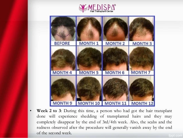 After Hair Transplant Hair Growth Timeline